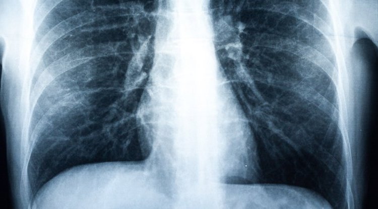 全球首例因吸电子烟导致的双肺移植手术.jpg