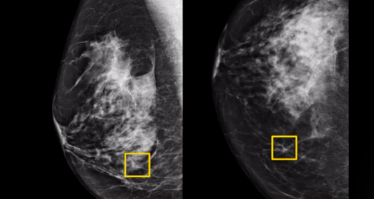 谷歌人工智能系统可以提高乳腺癌检测的准确性.png